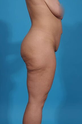 before abdominoplasty right side view female patient case 1000