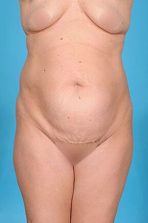 before abdominoplasty front view female patient case 970