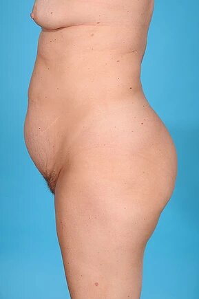 before abdominoplasty left side view female patient case 970