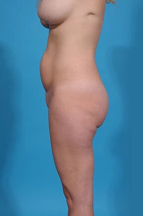 before abdominoplasty left side view female patient case 975