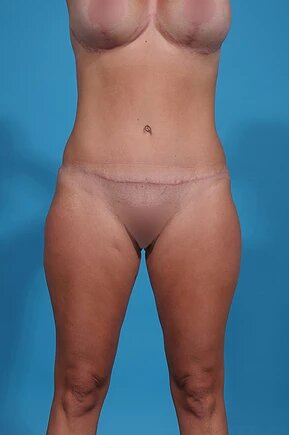 after abdominoplasty front view female patient case 975