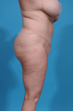 after abdominoplasty right side view female patient case 980