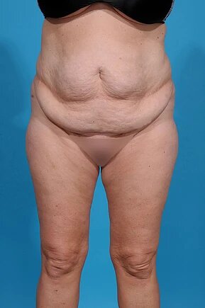 before abdominoplasty front view female patient case 980