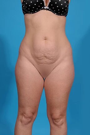 before abdominoplasty front view female patient case 985