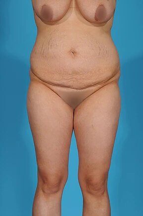before abdominoplasty front view female patient case 990