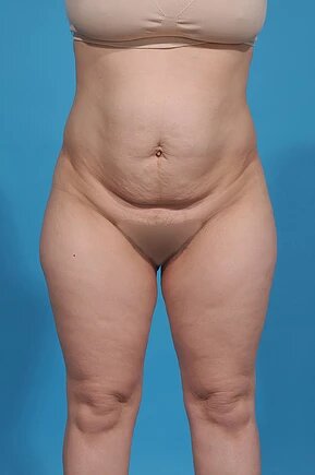 before abdominoplasty front view female patient case 995