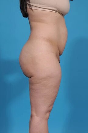 before abdominoplasty right side view female patient case 995