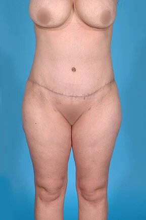 after abdominoplasty front view female patient case 995