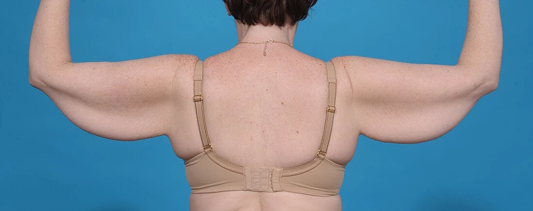 before arm lift back view female patient case 1196