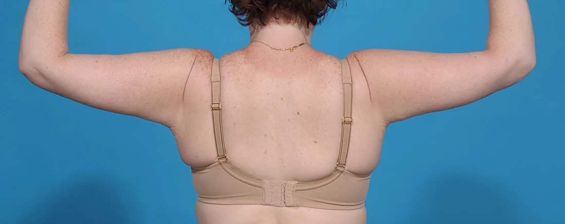 after arm lift back view female patient case 1196