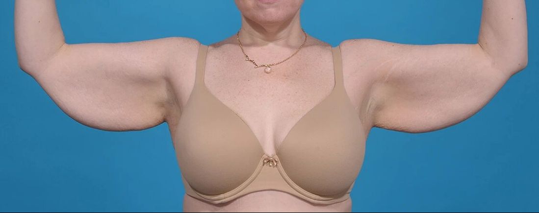 before arm lift front view female patient case 1196