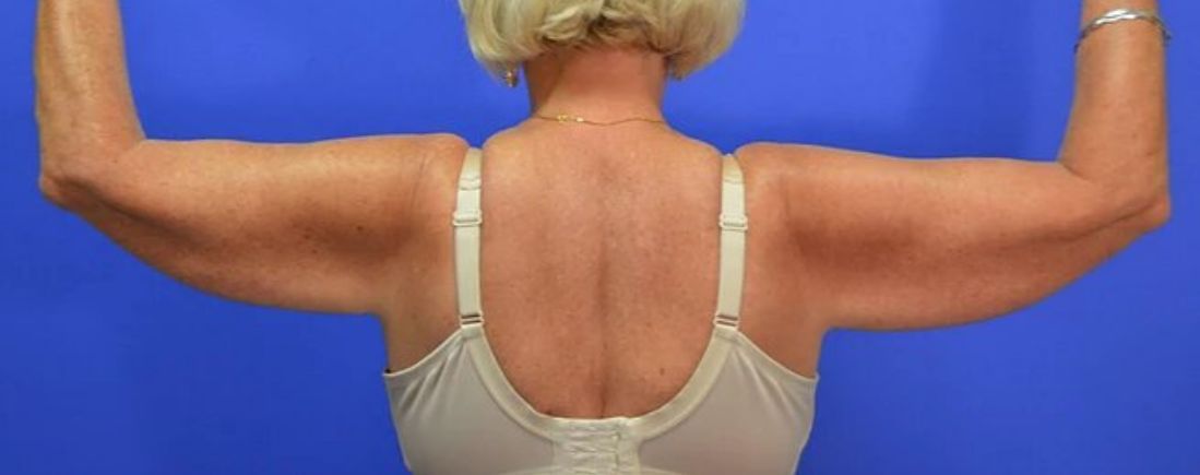 before arm lift back view female patient case 1201