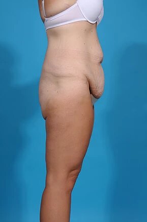 before body lift right side view female patient case 679