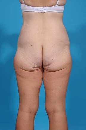 before body lift back view female patient case 679