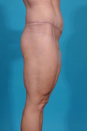 after body lift right side view male patient case 686