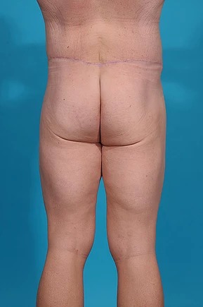 after body lift back view male patient case 686