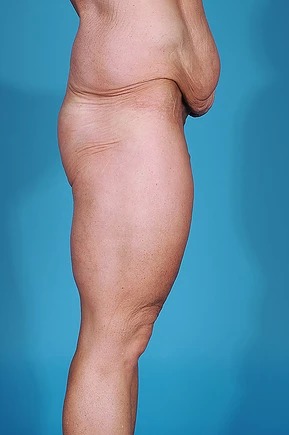 before body lift right side view male patient case 686