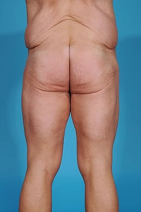 before body lift back view male patient case 686