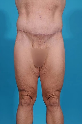 after body lift front view male patient case 686