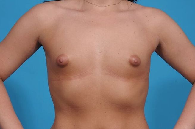 before breast augmentation front view female patient case 735
