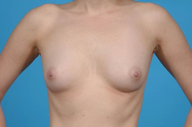 before breast augmentation front view female patient case 725
