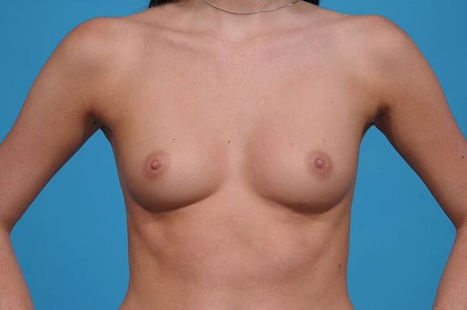 before breast augmentation front view female patient case 745