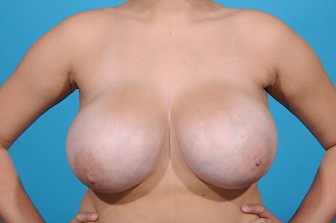 breast reduction before front view