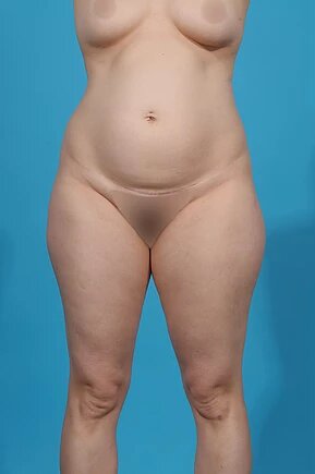 before liposuction front view female patient case 945