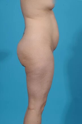 before liposuction right side view female patient case 945