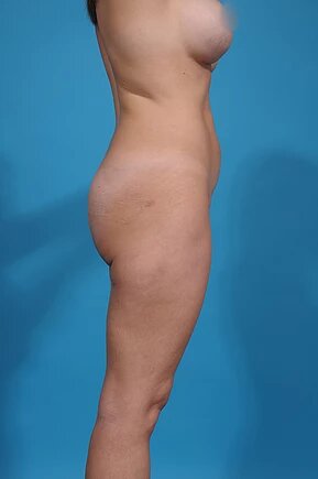 after liposuction right side view female patient case 960
