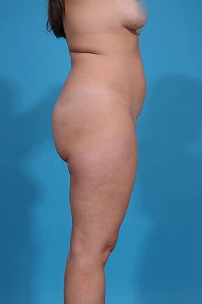 before liposuction right side view female patient case 960
