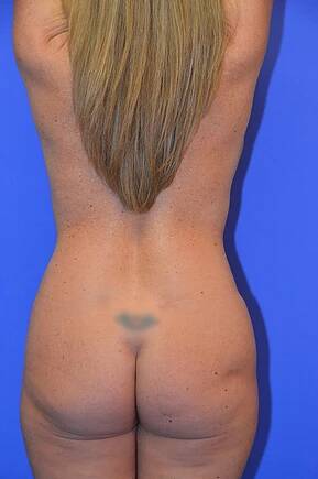 after mommy makeover back view female patient case 1186