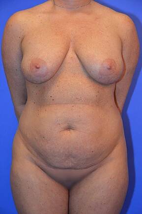 before mommy makeover front view female patient case 1186