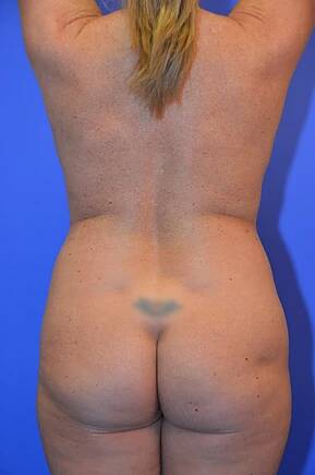 before mommy makeover back view female patient case 1186