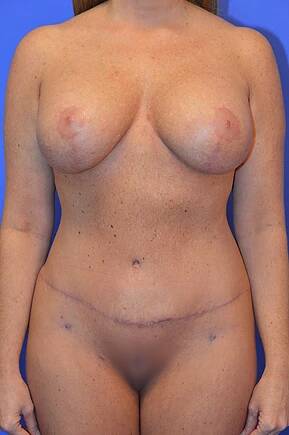 after mommy makeover front view female patient case 1186