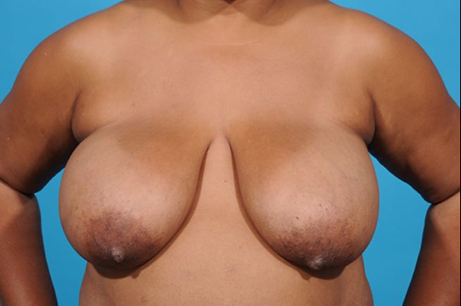 before breast reconstruction front view female patient case 2259