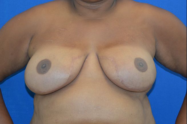after breast reconstruction front view female patient case 2259