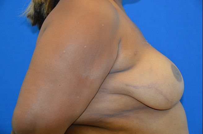 after breast reconstruction right side view female patient case 2259