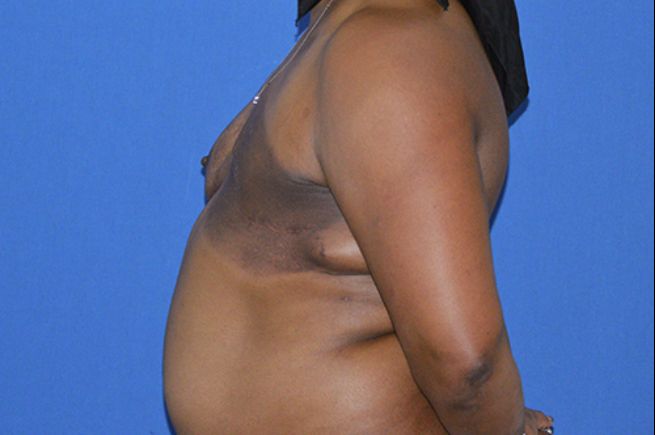 before breast reconstruction left side view female patient case 2269