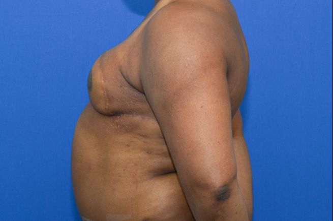 after breast reconstruction left side view female patient case 2269