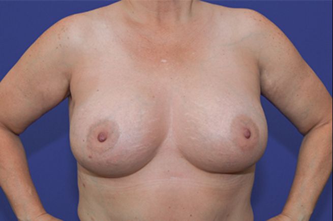 after breast revision front view female patient case 2274