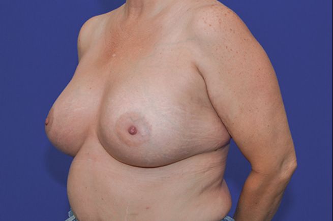 after breast revision left angle view female patient case 2274