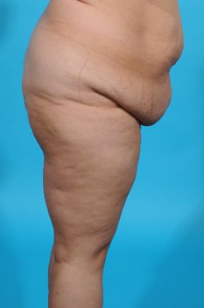 before abdominoplasty right view female patient case 2455