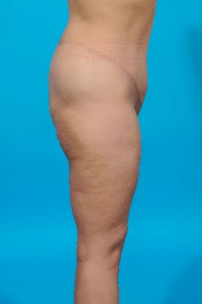 after abdominoplasty right view female patient case 2455