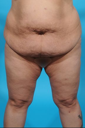 before abdominoplasty front view female patient case 2455