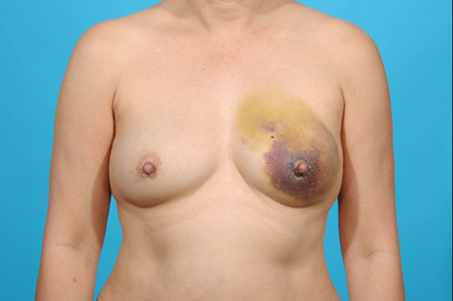 before breast reconstruction front view female patient case 2465