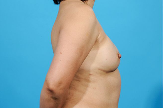 after breast reconstruction right view female patient case 2465