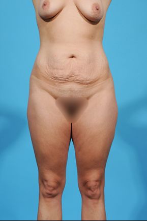 before mommy makeover front closeup view female patient case 2470