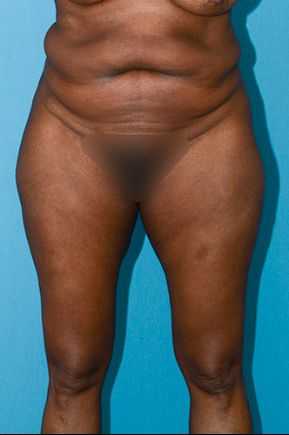 before abdominoplasty front view female patient case 2528