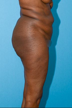 before abdominoplasty right side view female patient case 2528